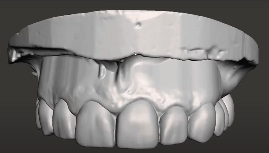 3D-nyomtatott fogakat és új állkapcsot kapott a tengerészgyalogos (a kép illusztráció)