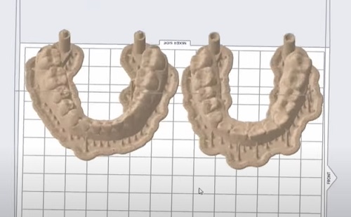 Új normává válik a 3D nyomtatás a fogászatban