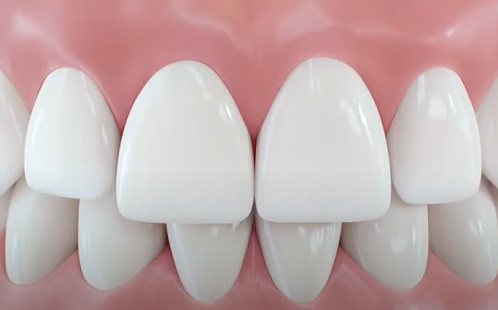 Tudjuk-e, miből áll össze a fogászati implantátum?