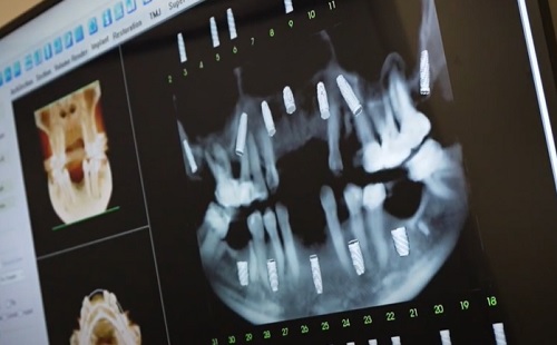 Egyfogú vagy teljesívű? - Az egynapos fogászati implantátumok típusai
