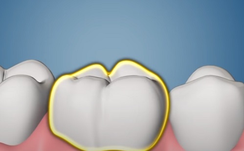Intő jelek, hogy fogászati implantátumra van szükségünk -  1.rész