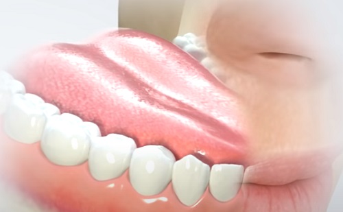 Mi a fogászati implantátum és milyen fajtái vannak?