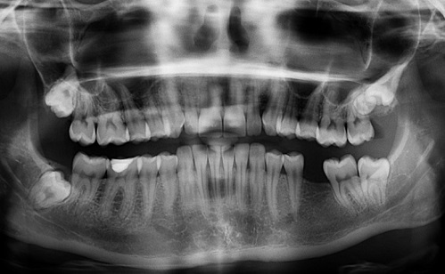 Röntgen a fogorvosnál? - Modern technológiákkal már teljesen biztonságos