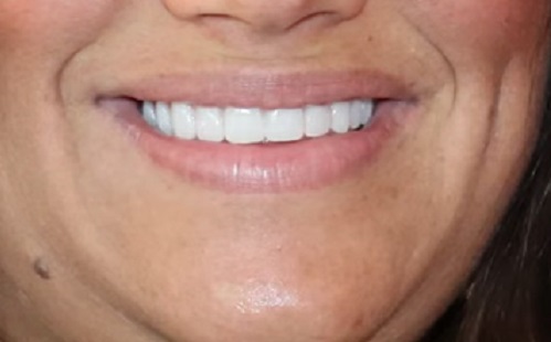 Krónikus állapotokon is segíthet egy jó fogimplantátum