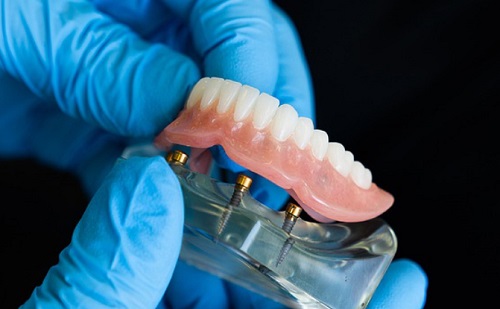 Ilyen előnyökkel jár a 3D nyomtatás a fogászatban
