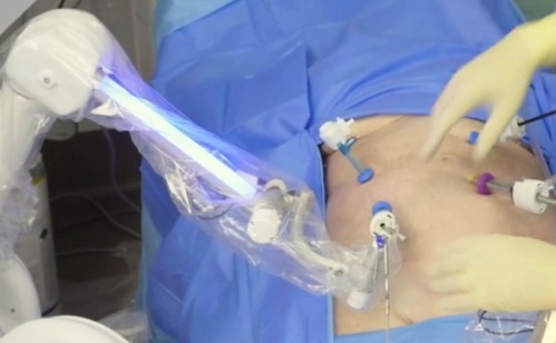 Robotikai műtétekben verhetetlen a Moon Surgical rendszer
