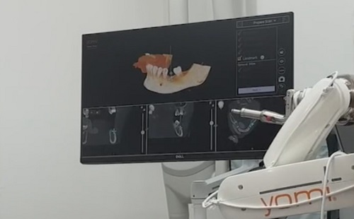 Óriási precizitást ígér a fogászati robot a fogimplantációban
