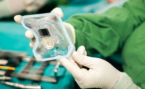 A világ első okos cochleáris implantátumát kapta egy magyar kisfiú Szegeden