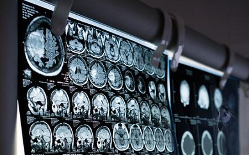 Segíthet a mesterséges intelligencia a következő stroke megelőzésében?