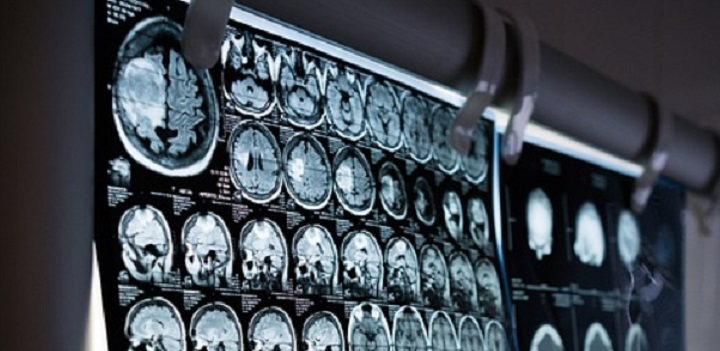 Agydaganatok esélyét mutatja meg a mesterséges intelligencia - és nem is drága